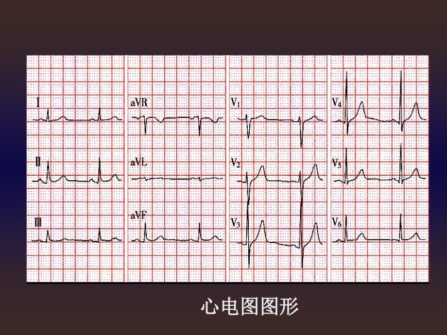 本心电图ppt课件_第4页