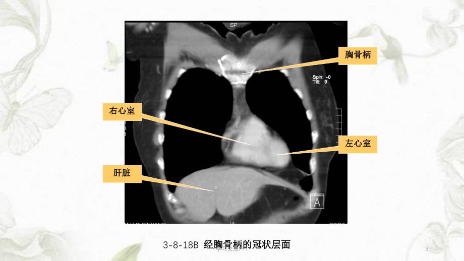 胸部冠状面、矢状面解剖与影像课件_第3页