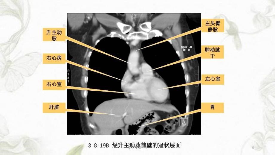 胸部冠状面、矢状面解剖与影像课件_第5页