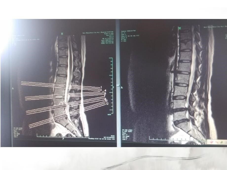 腰间盘突出护理查房_第5页