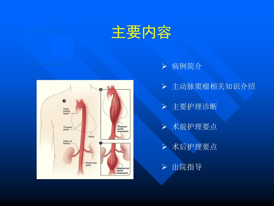 主动脉夹层动脉瘤围手术期教学查房ppt课件_第2页