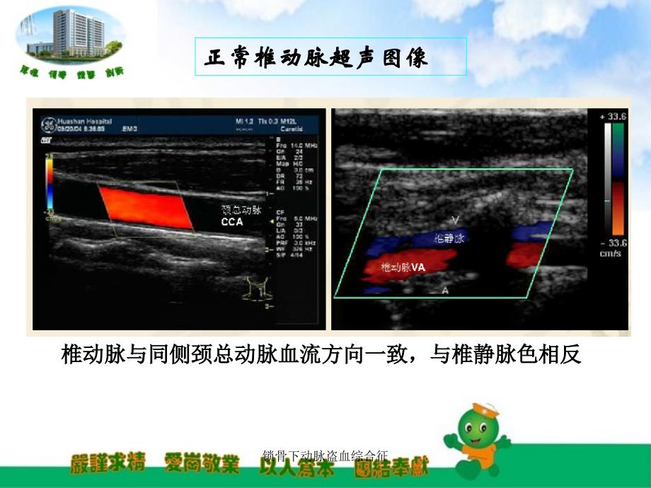 锁骨下动脉盗血综合征_第3页