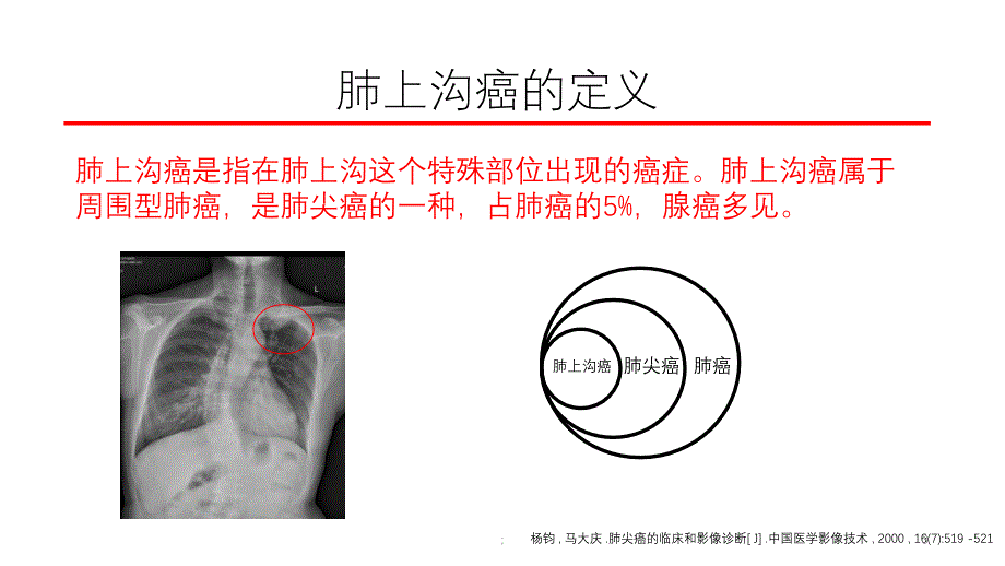 肺上沟癌的鉴别诊断ppt课件_第3页