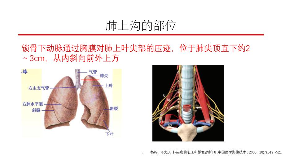 肺上沟癌的鉴别诊断ppt课件_第4页