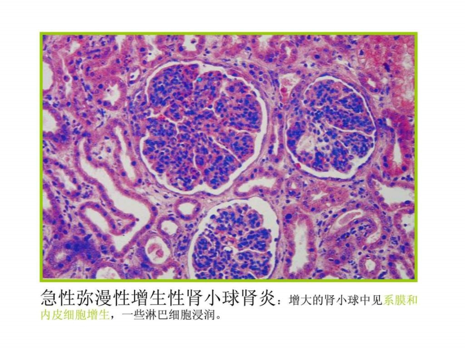 17.毙em肾小球肾炎.ppt_第2页