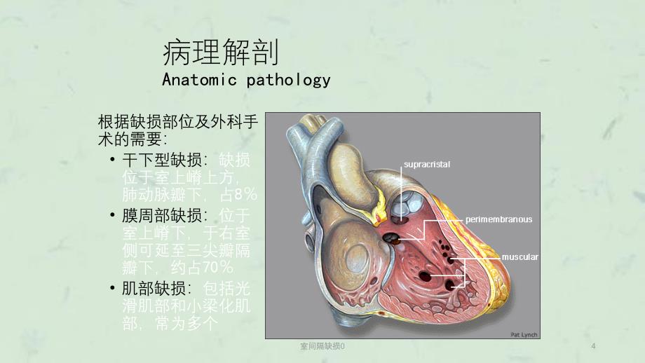 室间隔缺损0课件_第4页