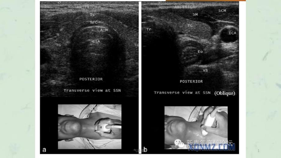 气道超声课件_第1页