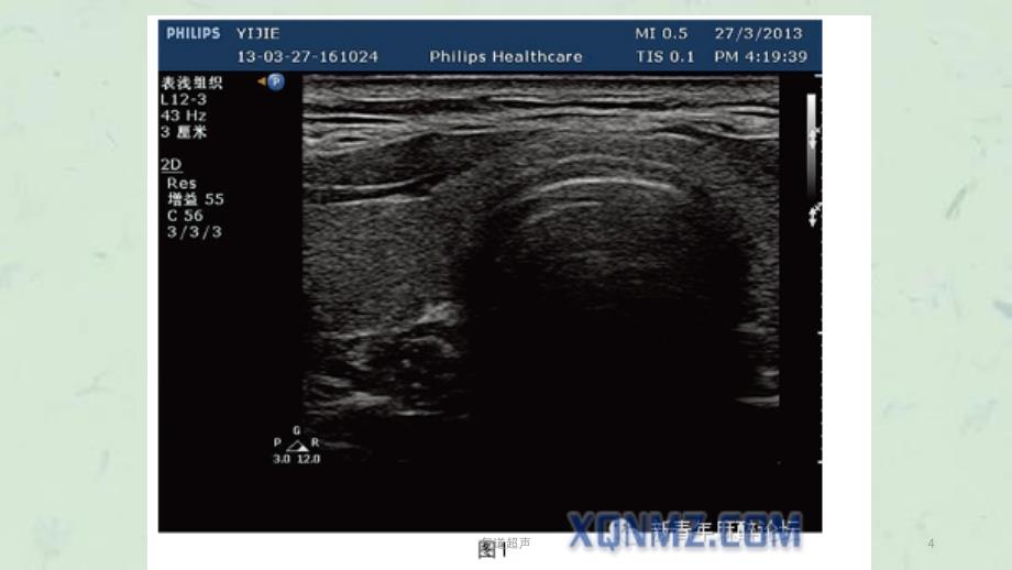 气道超声课件_第4页