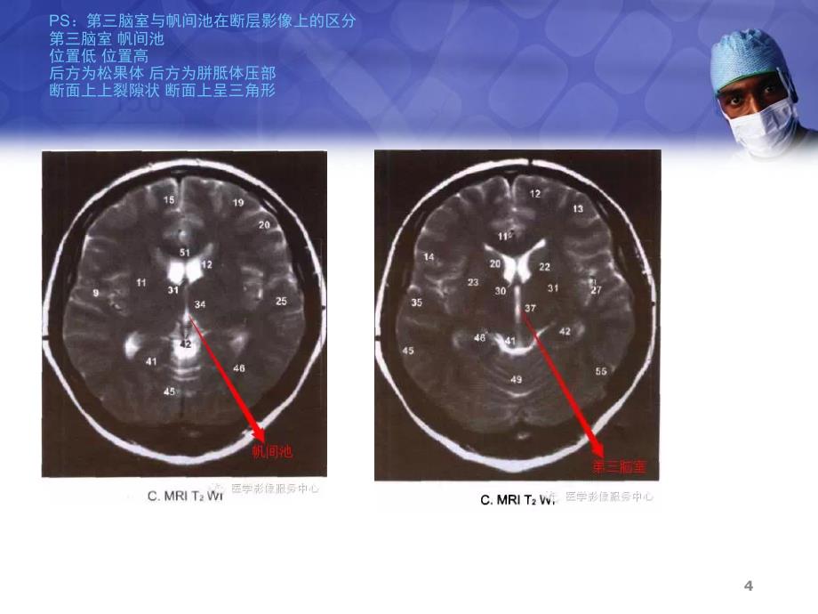 医学PPT课件脑室的划分图文详解_第4页