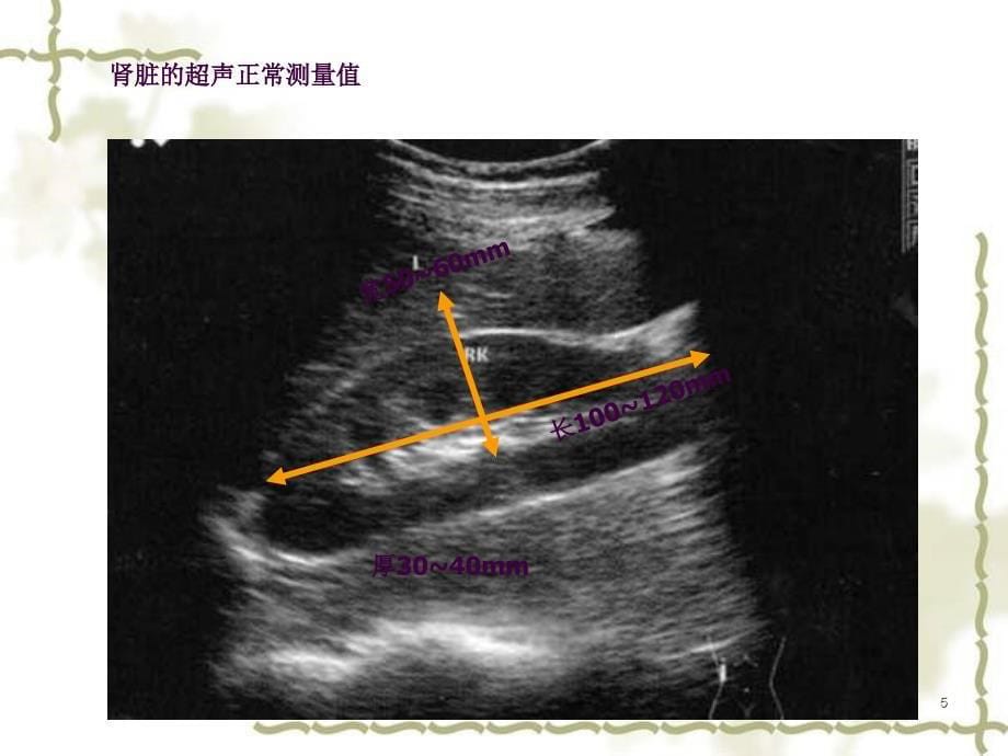 泌尿系超声ppt课件_第5页