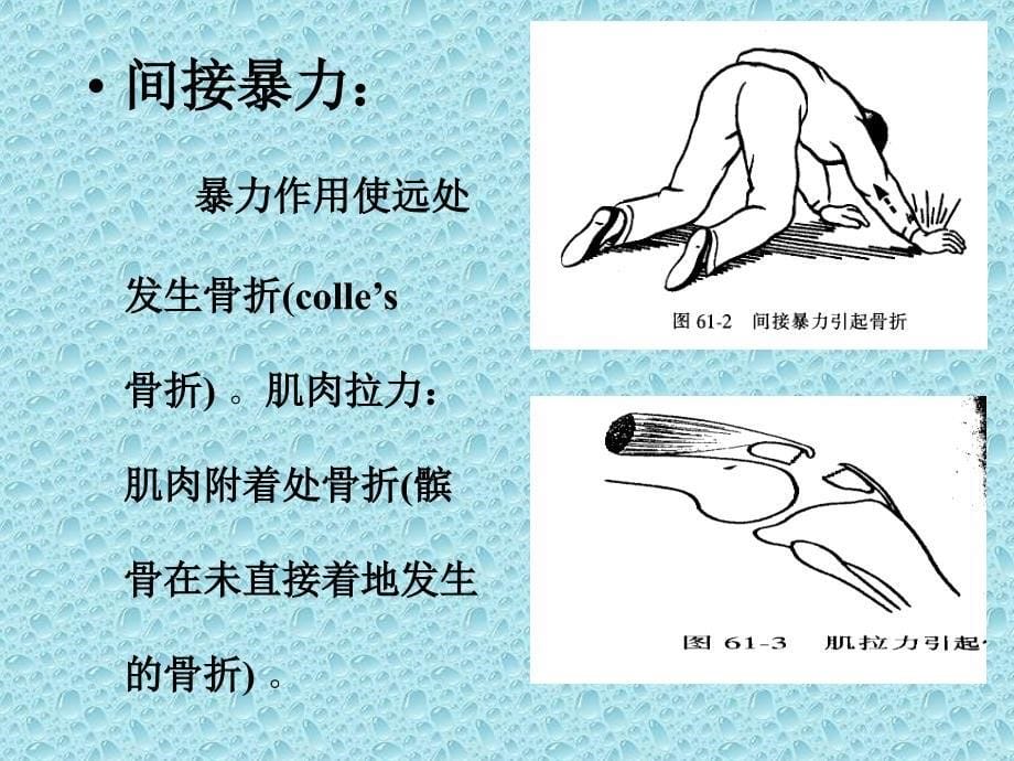 外固定支架1课件_第5页