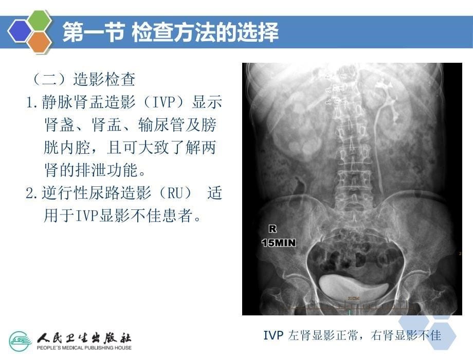 泌尿系统与肾上腺演示教学_第5页