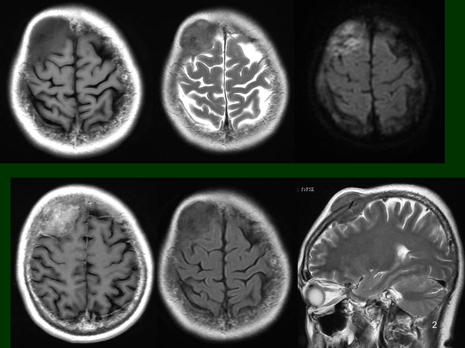 颅内淋巴瘤CTMR诊断与鉴别PPT课件_第2页