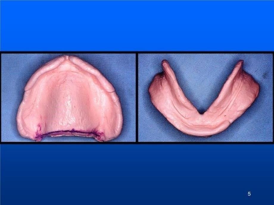 【精品】全口义齿-印模与模型精品ppt课件_第5页