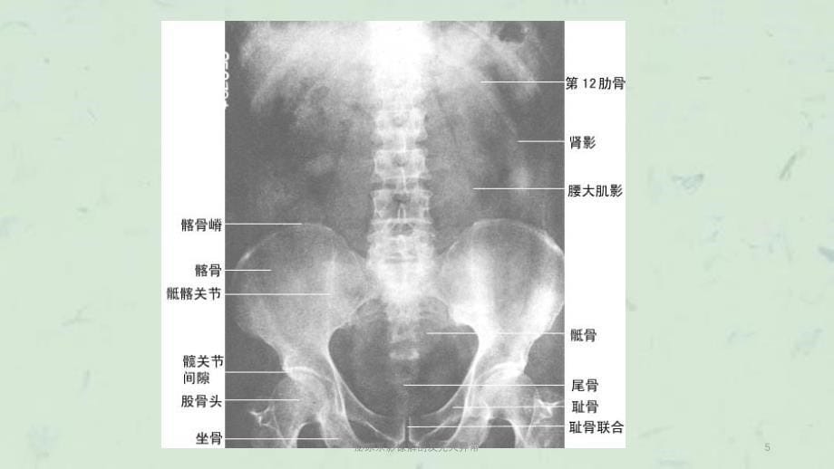 泌尿系影像解剖及先天异常课件_第5页