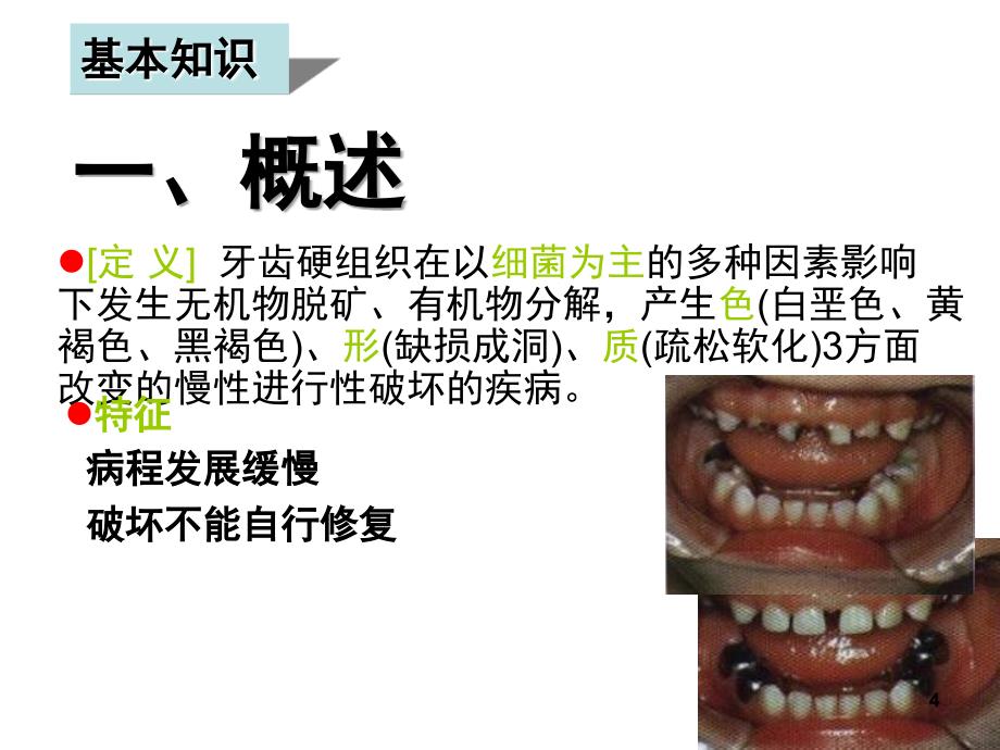 学习情境11龋病的基本知识PPT课件_第4页