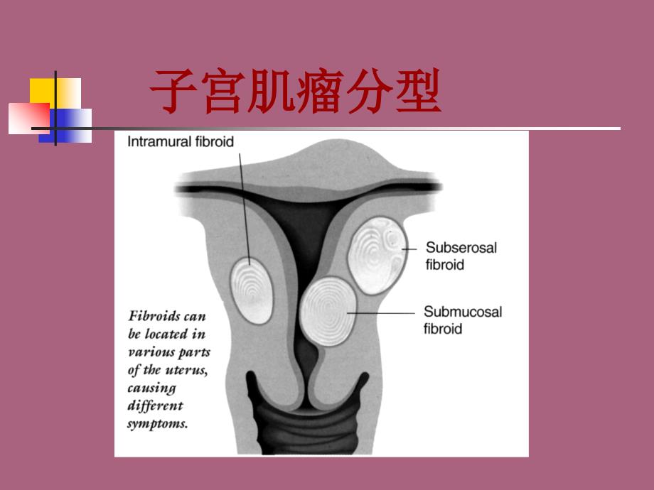 介入治疗在妇科的应用ppt课件_第4页