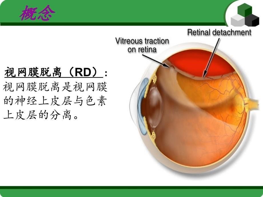 视网膜脱落护理ppt课件_第5页