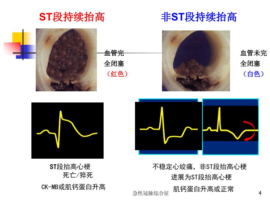 最新急性冠脉综合征_第4页