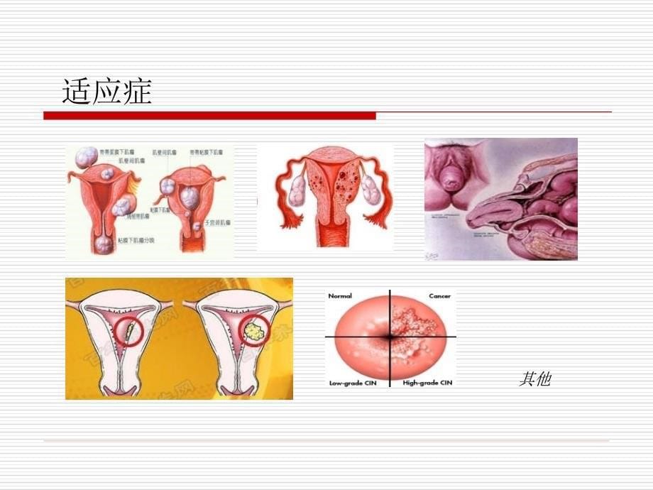 腹腔镜子宫切除术-2_第5页