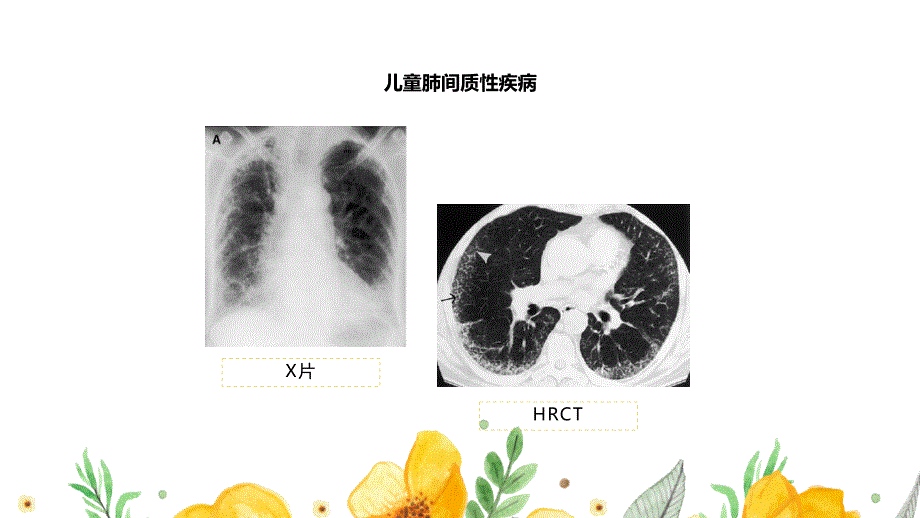 肺间质性疾病患者的诊疗护理 (1)_第4页