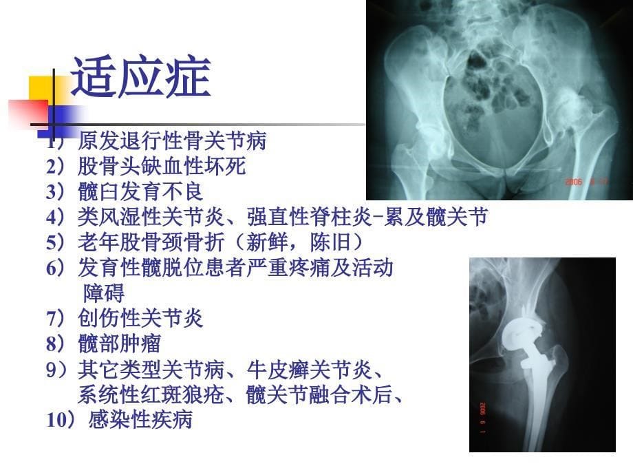 人工全髋关节置换术 ppt课件_第5页