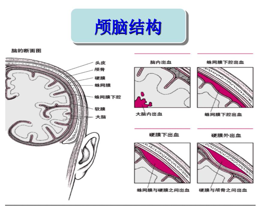 蛛网膜下腔出血的护理查房_第4页