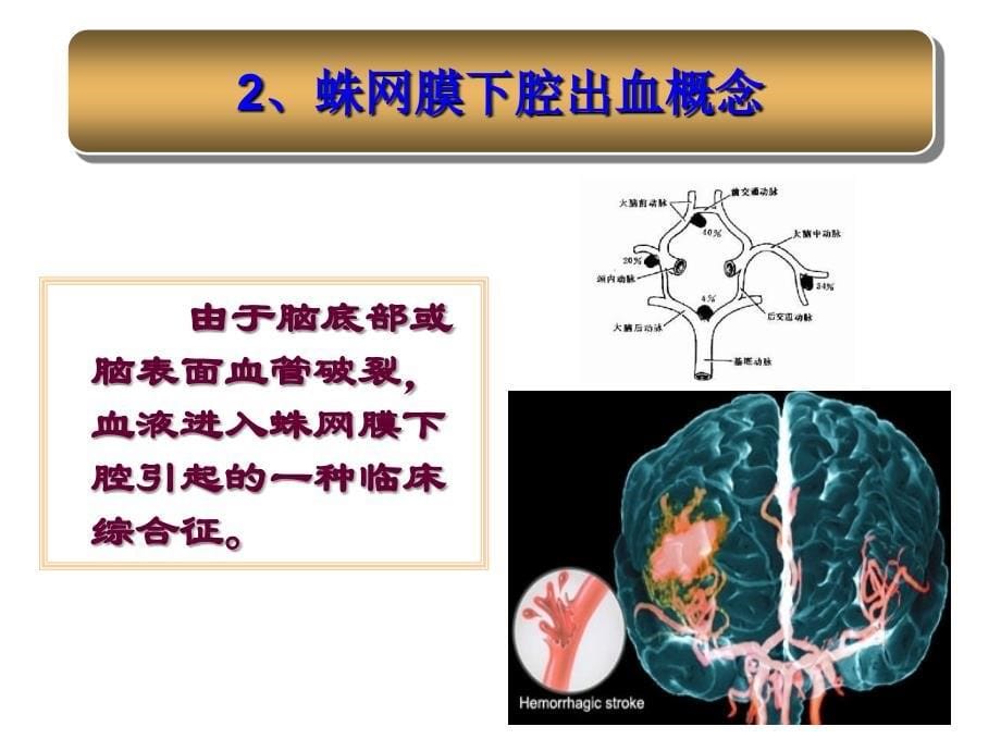 蛛网膜下腔出血的护理查房_第5页