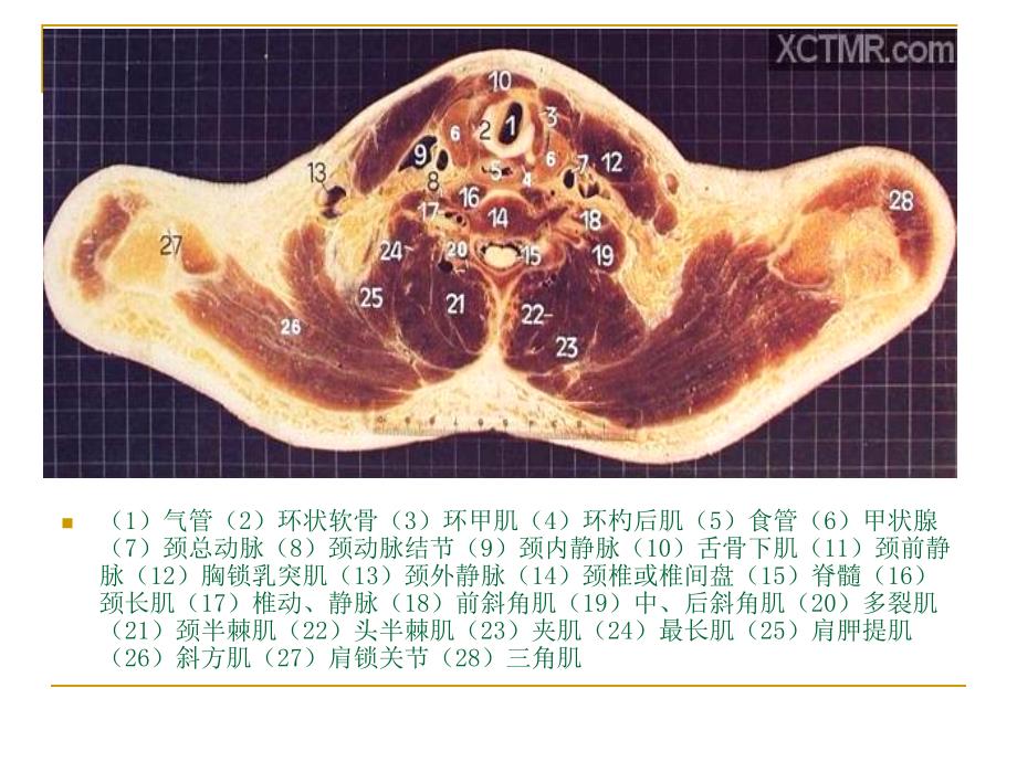 人体断层解剖图谱胸腔_第3页