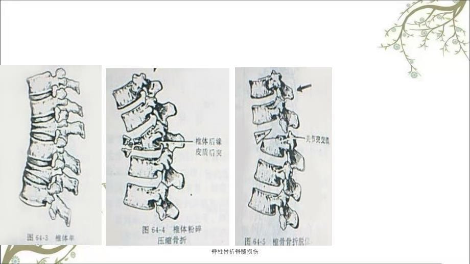 脊柱骨折脊髓损伤课件_第5页