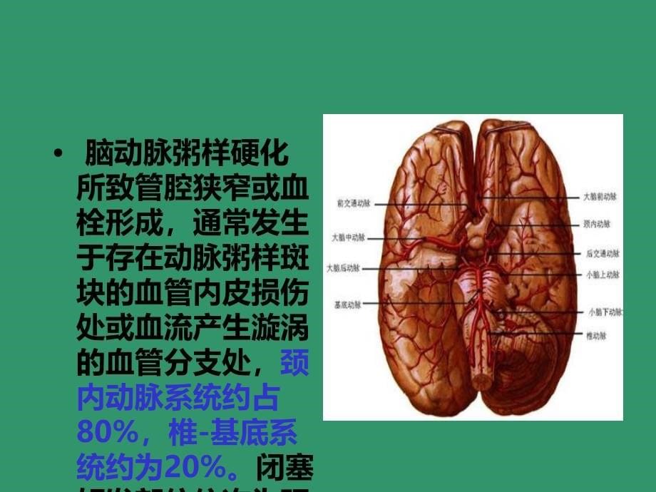 脑血栓形成课件_第5页