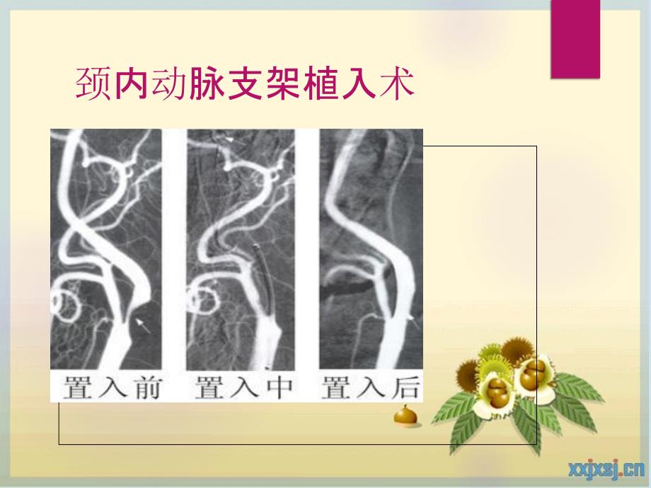 脑血管病介入治疗术前术后注意事项.ppt_第4页