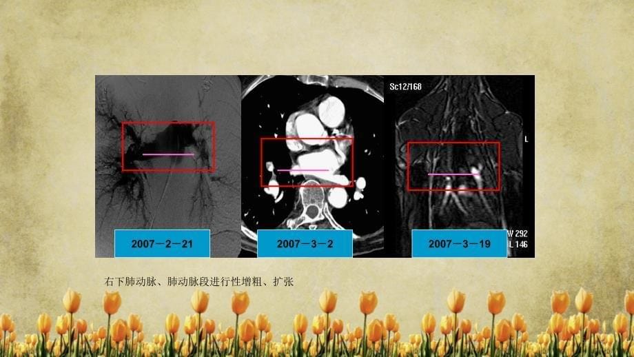 肺栓塞影像学诊断精选_第5页