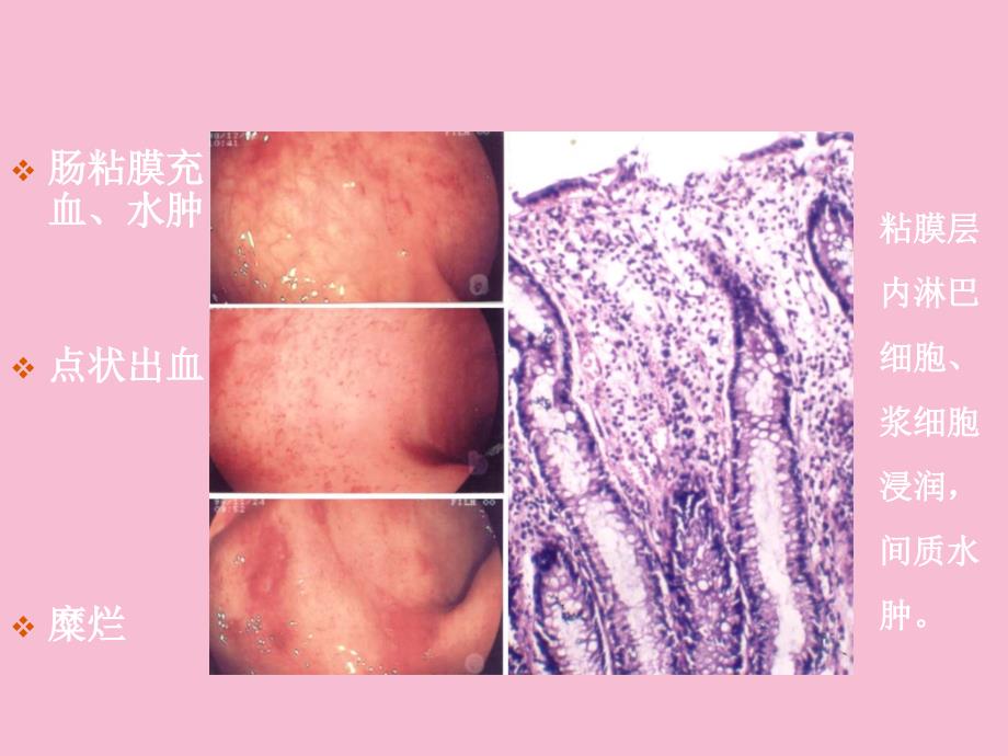 大肠疾病临床病理学2ppt课件_第4页