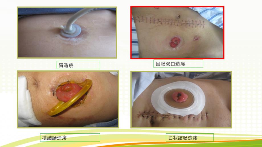 造口并发症的处理_第3页