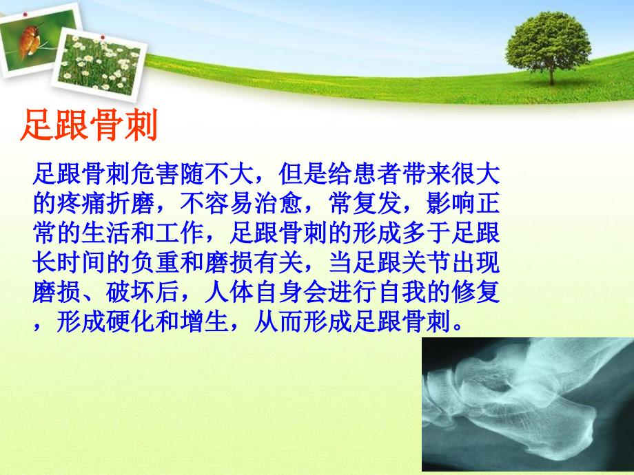 治疗足跟骨刺的方法.ppt_第2页