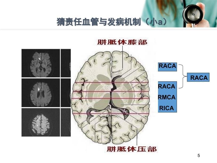 （优质课件）从影像学梗死部位推测责任供血血管_第5页