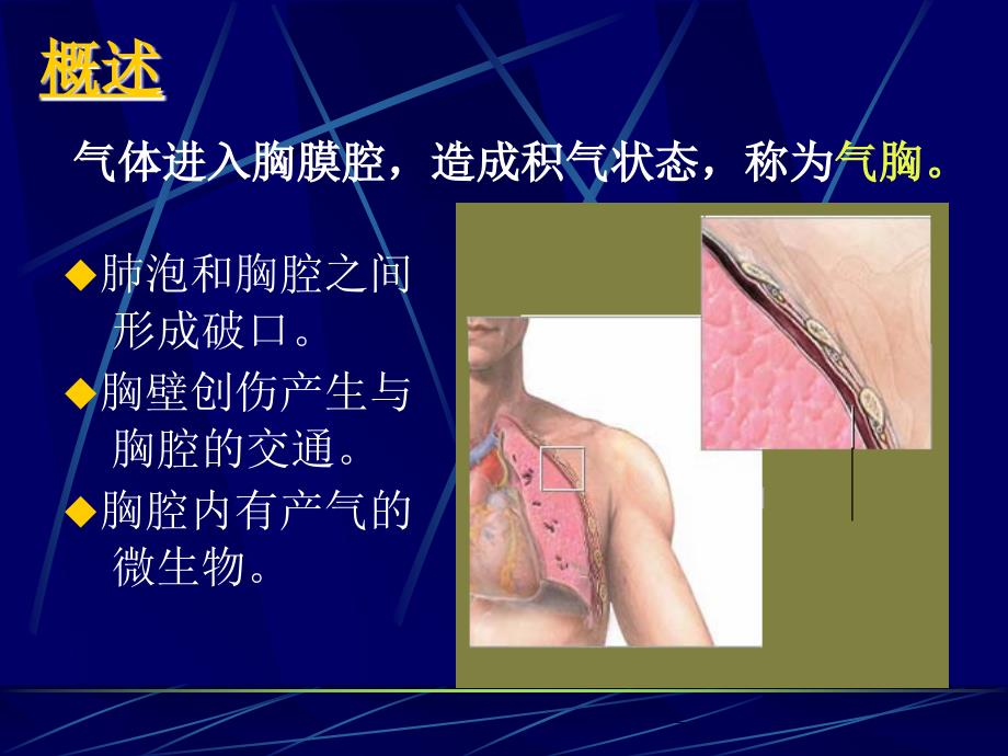 气胸PPTppt课件.ppt_第2页