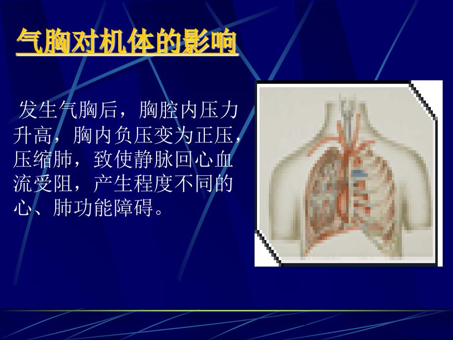 气胸PPTppt课件.ppt_第3页