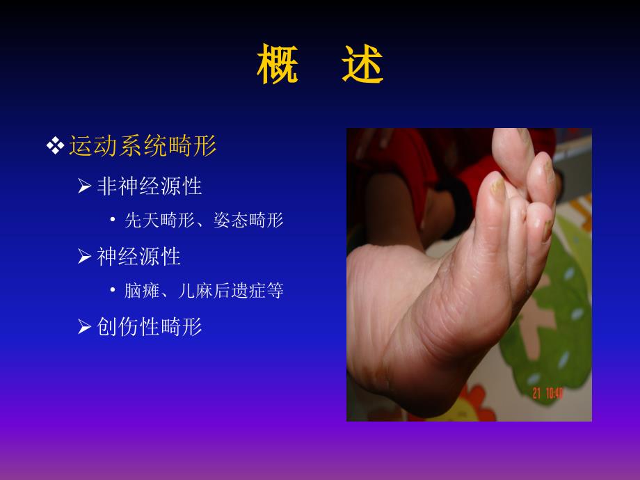 运动系统畸形.ppt_第4页