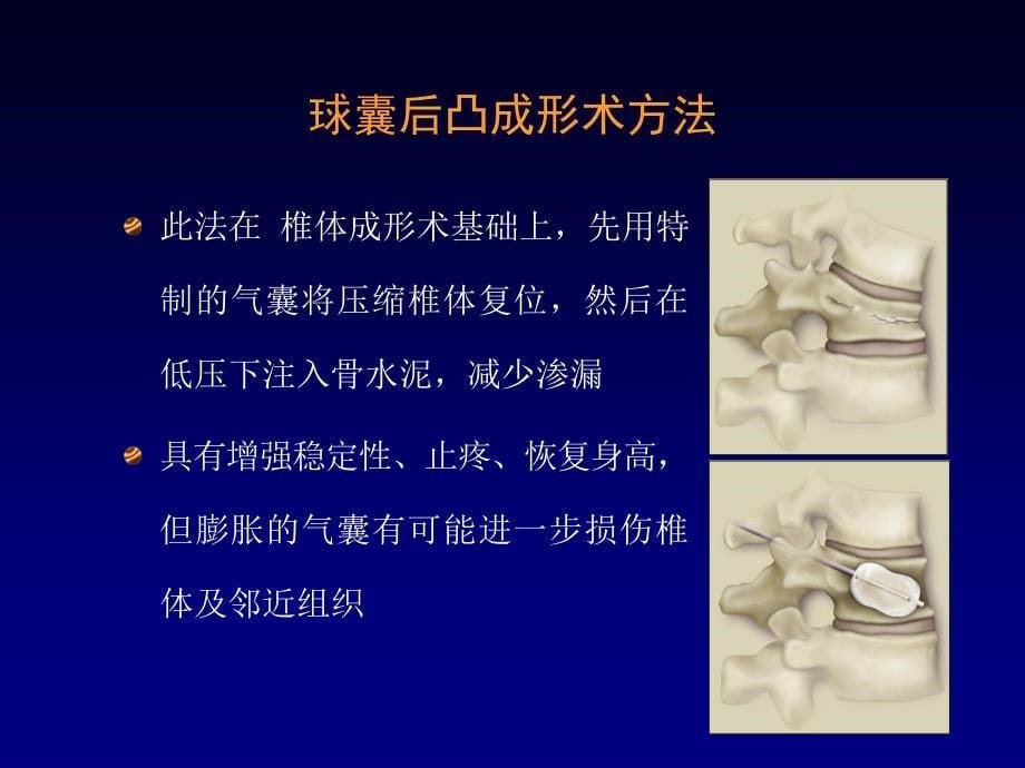 经皮椎体成形术.ppt_第5页