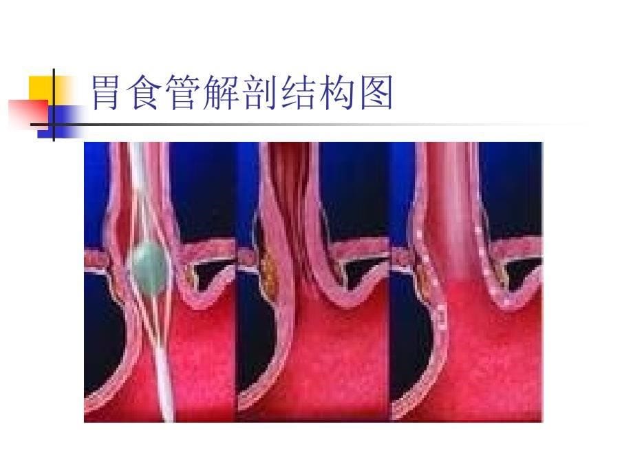 《胃食管反流病》PPT课件_第5页