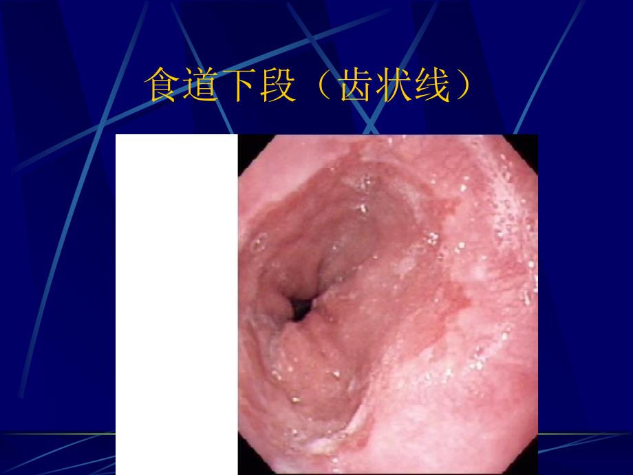 消化道疾病内镜下表现_第2页