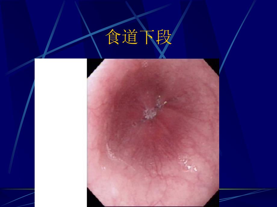 消化道疾病内镜下表现_第3页