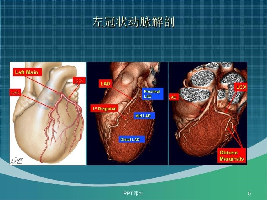 冠状动脉CTA的应用与报告解读课件_第5页