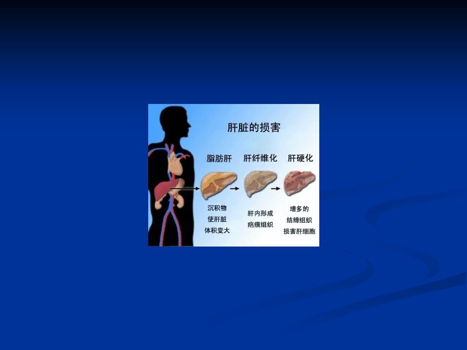 肝硬化失代偿护理常规 ppt课件_第2页