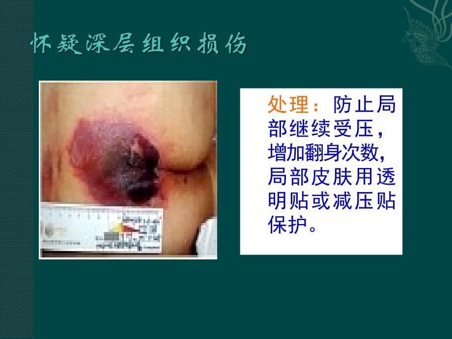 压疮的护理措施73411.ppt_第5页