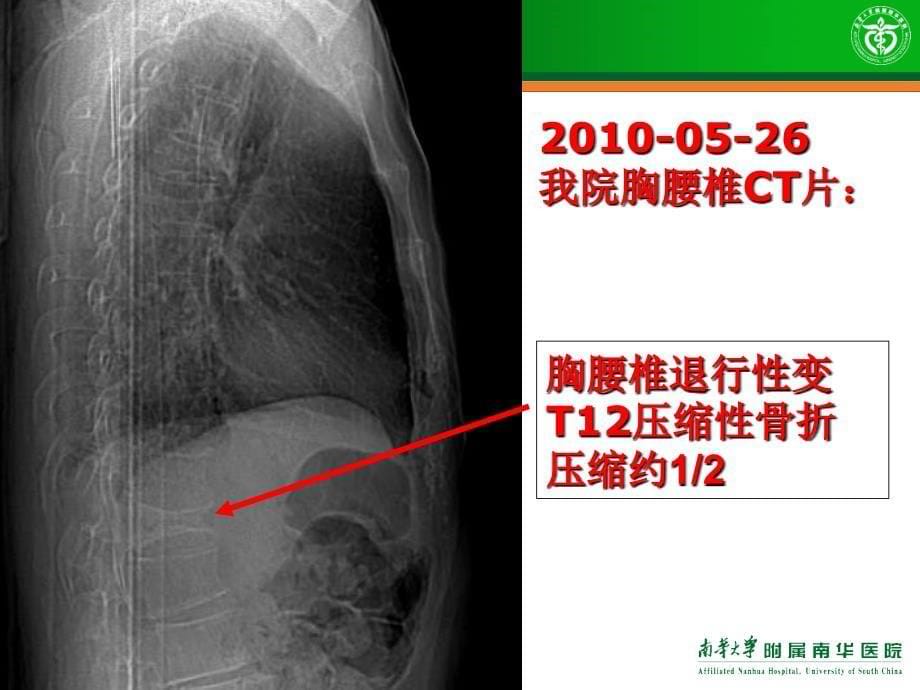 骨质疏松治疗方案的应用评价课件_第5页