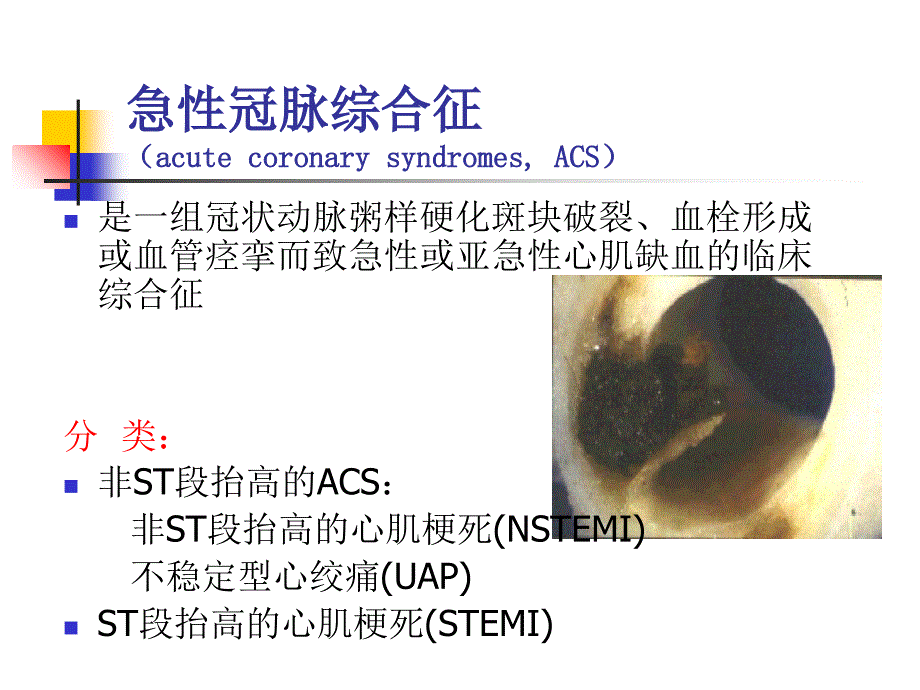 急性冠脉综合征的治疗策略_第2页