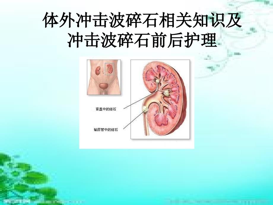 体外冲击波碎石术及护理终结版ppt课件_第2页